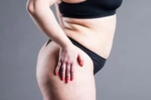 IF THERE’S NO CURE, HOW DO YOU TREAT LIPEDEMA?