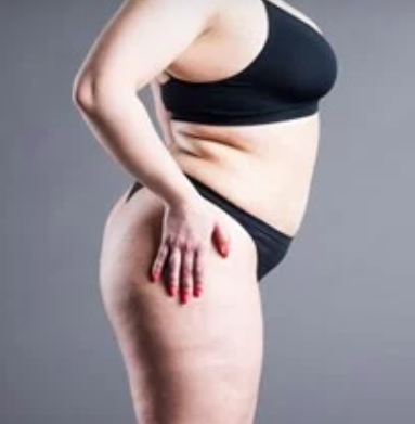 How Can I Slow the Likely Progression of My Lipedema? - Total Lipedema Care