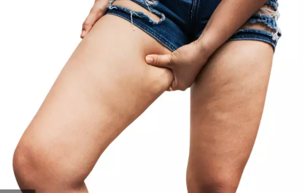 Lipedema  Fat Disorder - Causes, Stages, Symptoms, Diagnosis & Treatment