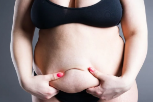 AM I A CANDIDATE FOR A TUMMY TUCK TO TREAT MY LIPEDEMA?