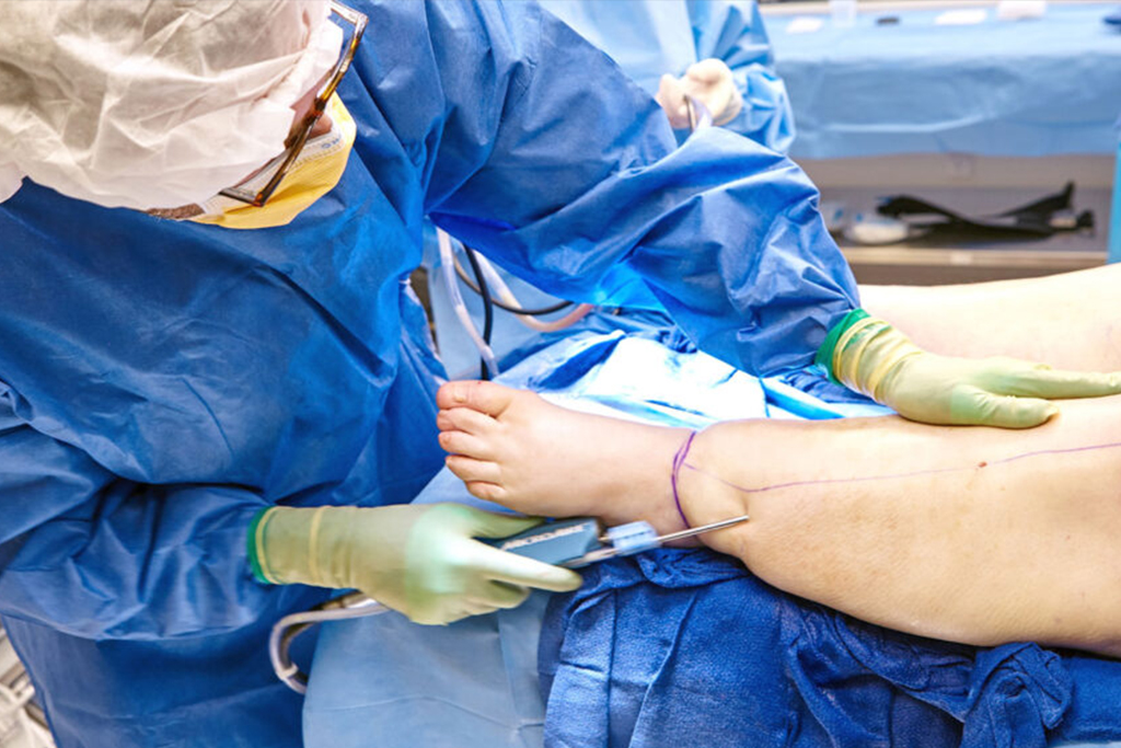 Manual Lipedema Extraction – Our Exclusive Technique Explained