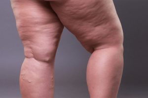 ?ARE FAT LEGS AT PUBERTY AN EARLY SIGN OF LIPEDEMA