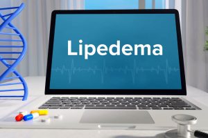 Lipedema Stages And Types