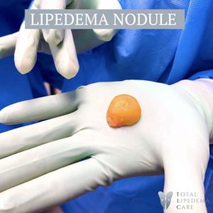 lipedema-nodule