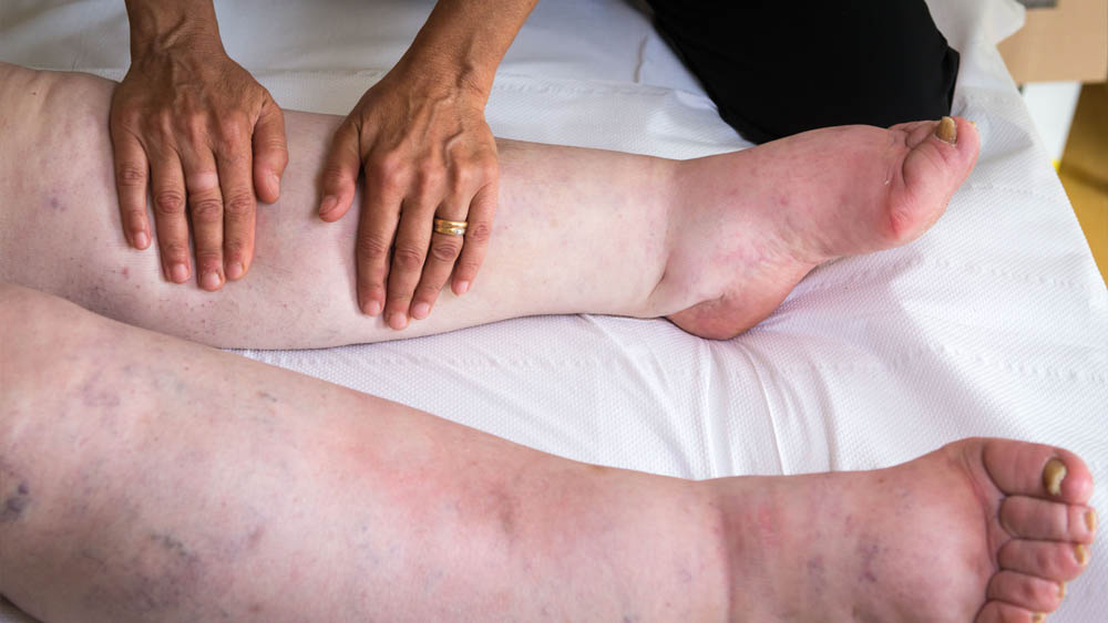 Lipedema and Lymphatic Drainage Massage:  What You Knead to Know
