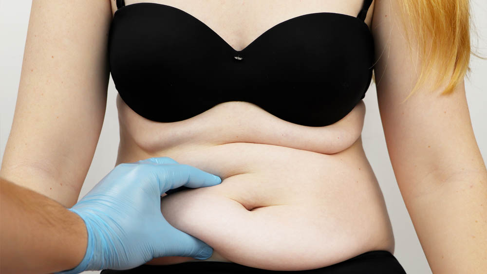 BMI Requirement for a Tummy Tuck?