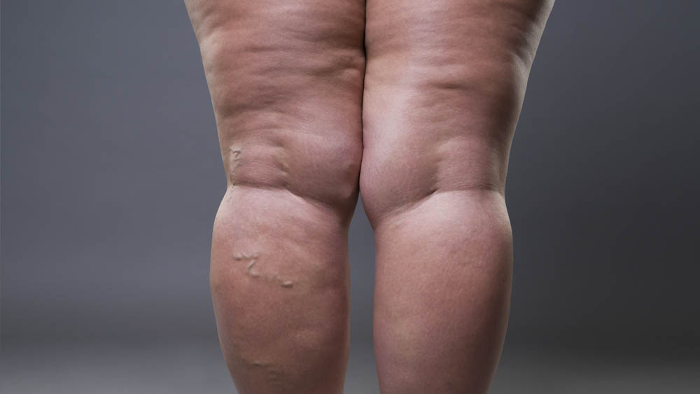 Taking a Stand Against Lipedema: Life After MLE
